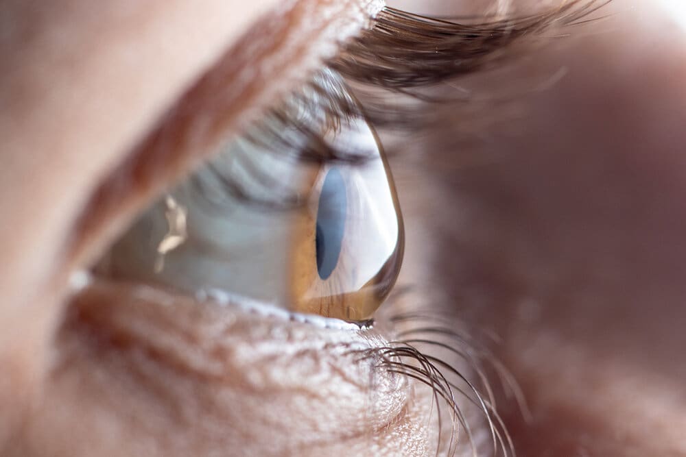 Eye with keratoconus Vision Care Clinic