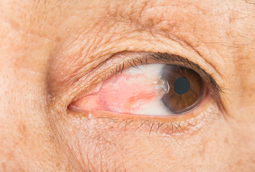 Eye pterygium in old women