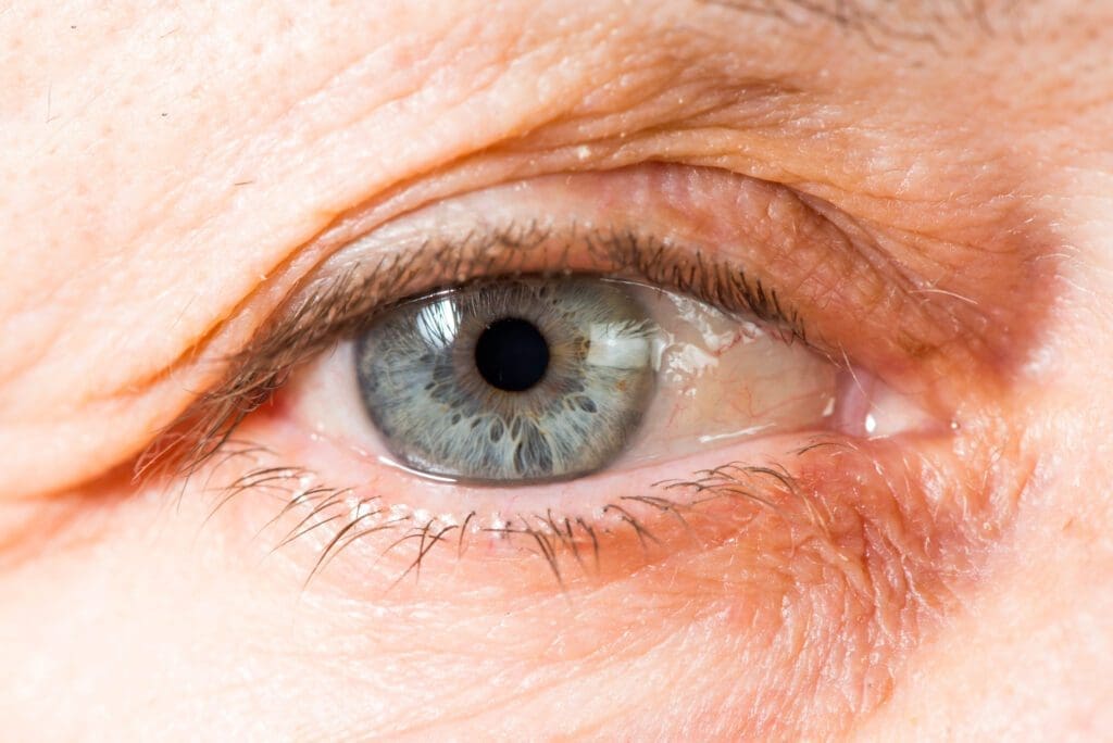 Glaucoma Eye | Eye Condition | Vision Care Clinic
