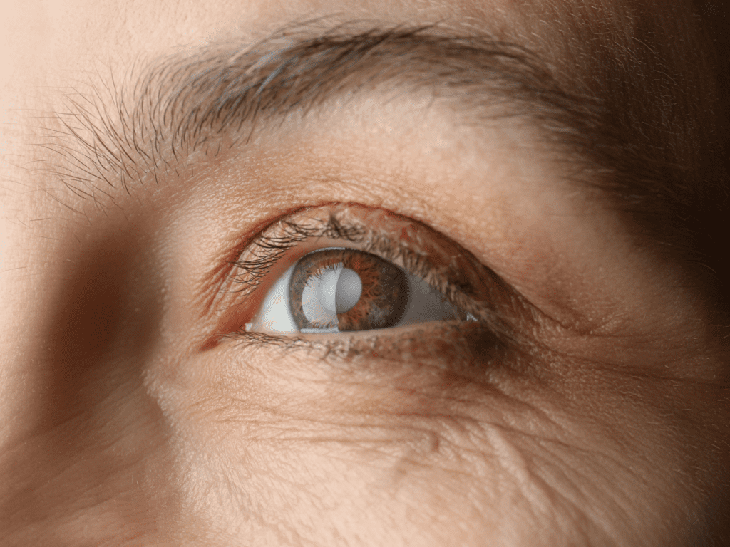 Cataract Surgery | Vision Care Clinic | Bristol 