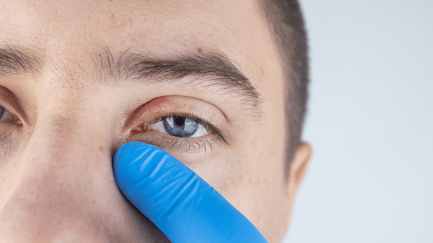 Blepharitis | Vision Care Clinic 