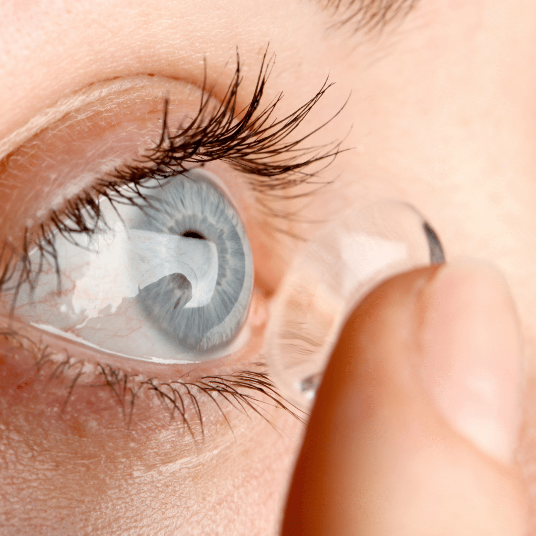 Contact Lenses | RLE Surgery