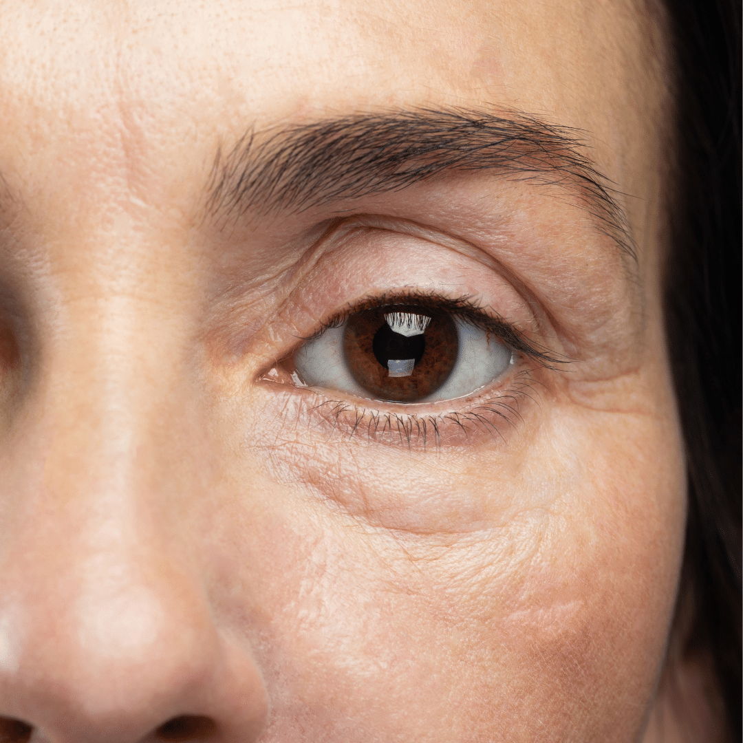 Upper Eyelid Surgery